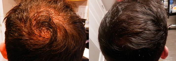Chronic Pain St. Petersburg FL Hair Restoration Services Chronic Pain St. Petersburg FL Hair Restoration Services
